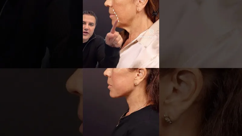 Before and after deep plane facelift, frontal view by Dr. Paul Afrooz