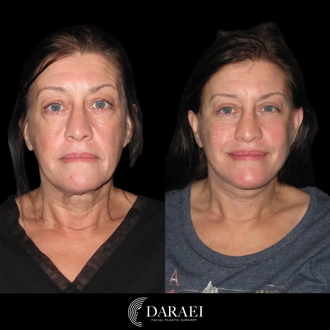 Before and after — Dr. Paul Daraei