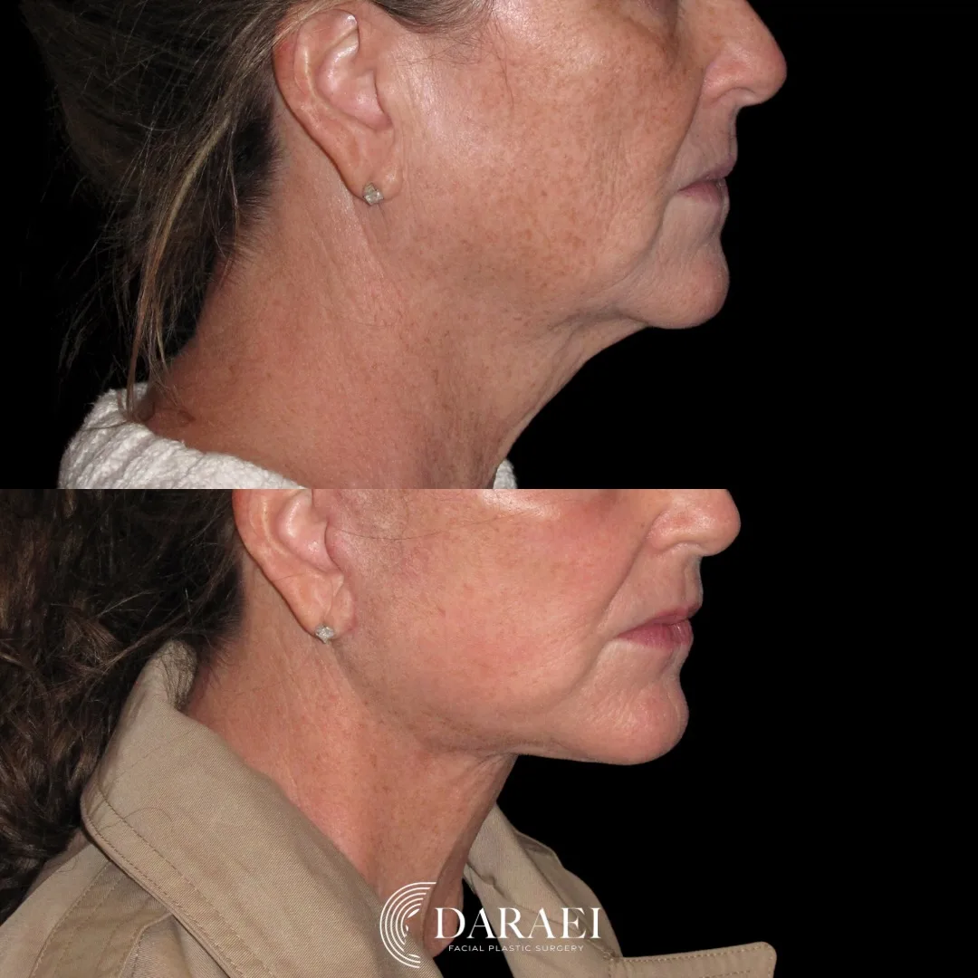 Before and after — Dr. Paul Daraei