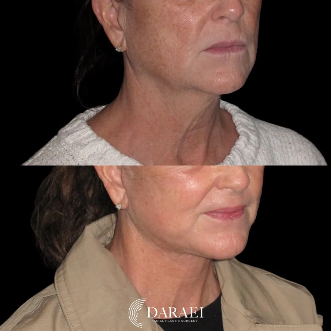 Before and after — Dr. Paul Daraei