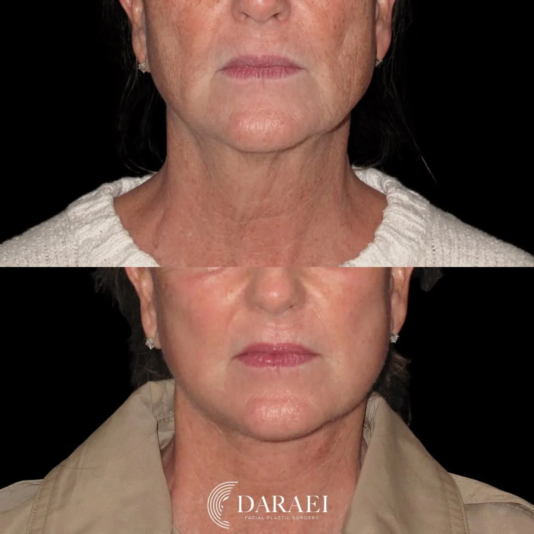 Before and after — Dr. Paul Daraei