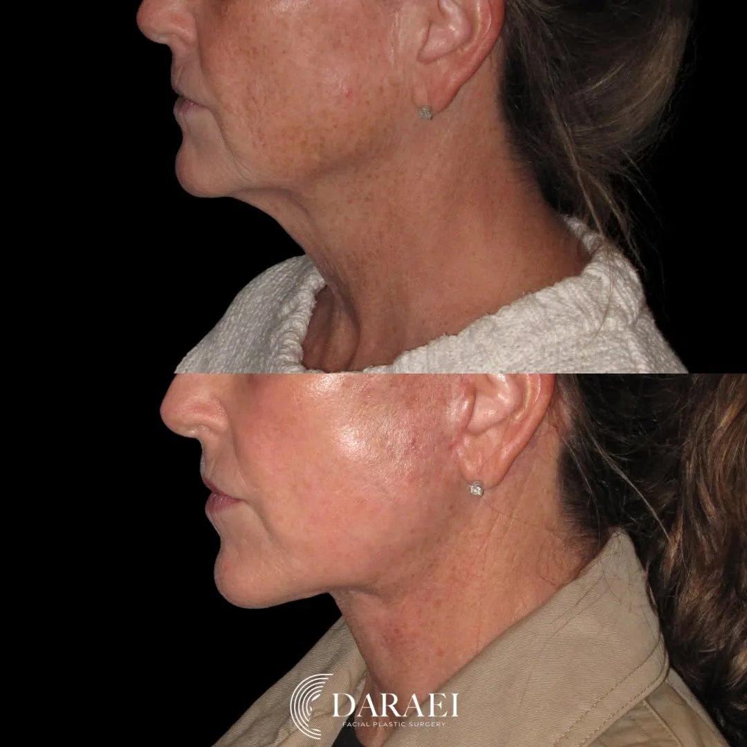 Before and after — Dr. Paul Daraei