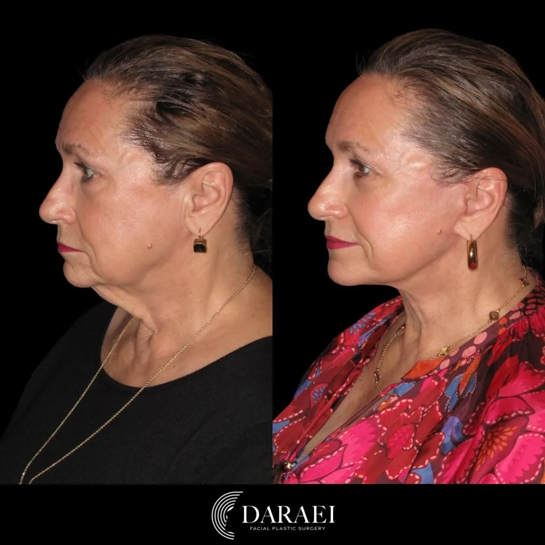 Before and after — Dr. Paul Daraei