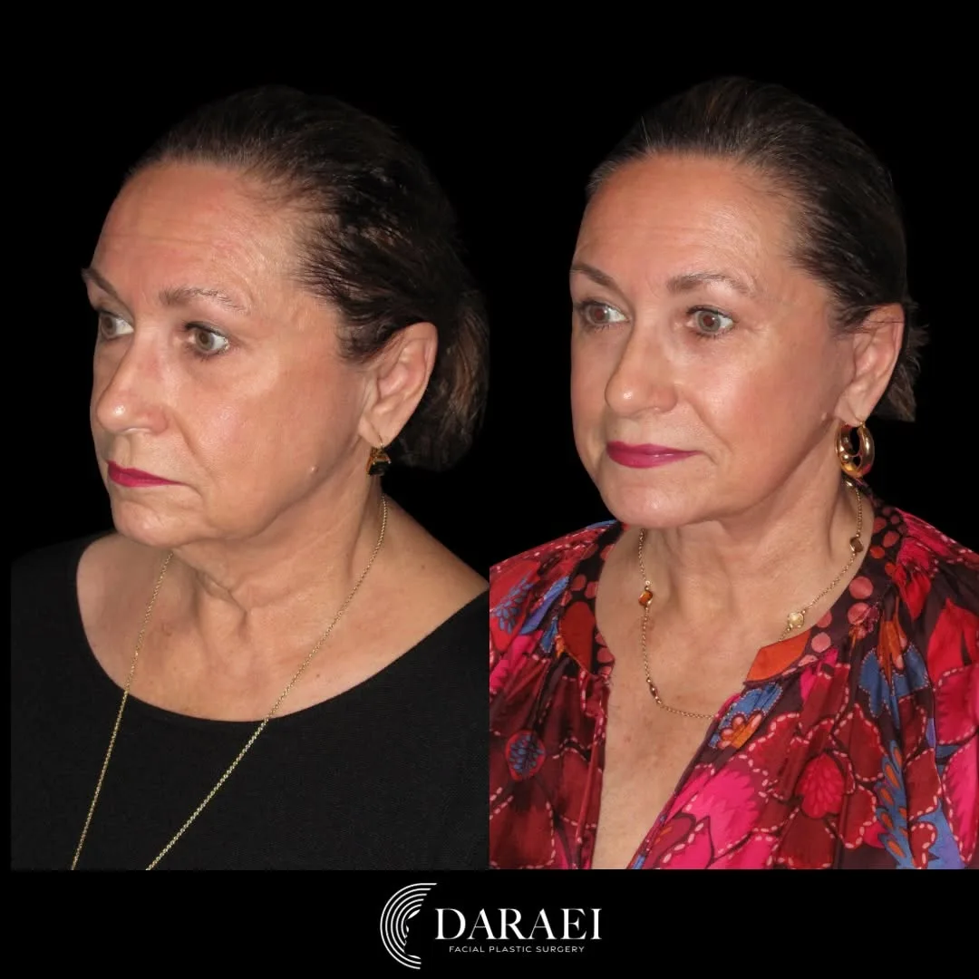 Before and after — Dr. Paul Daraei