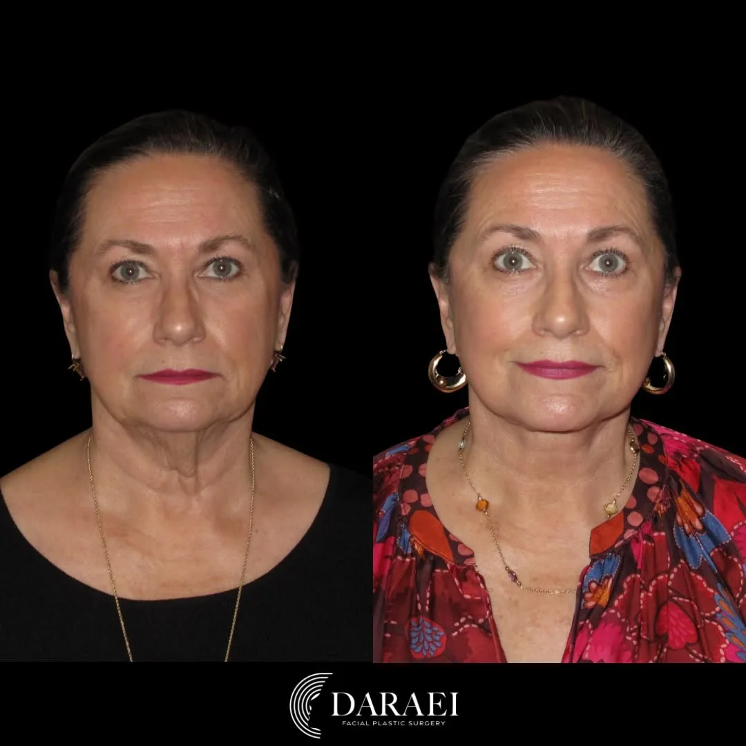 Before and after — Dr. Paul Daraei