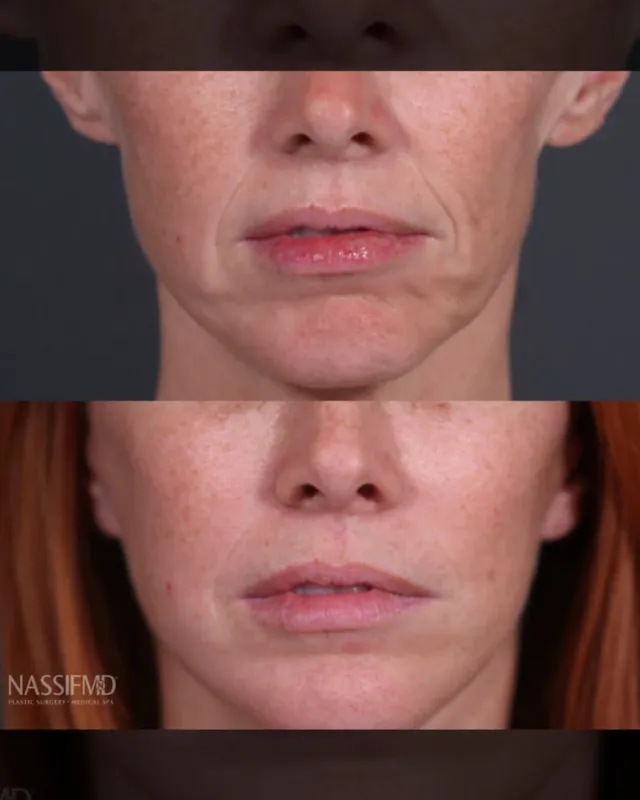 Before and after deep plane facelift, frontal view by Dr. Paul Nassif