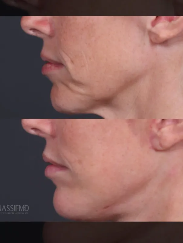 Before and after deep plane facelift, frontal view by Dr. Paul Nassif
