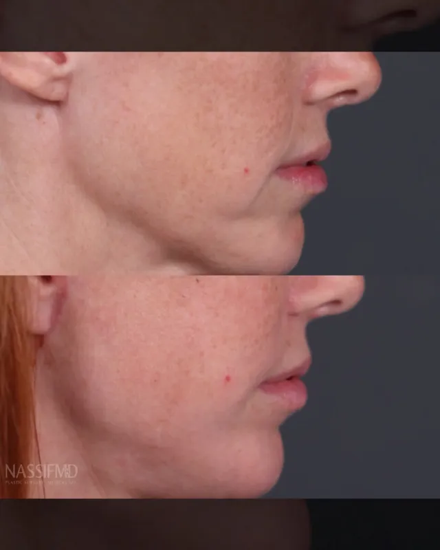 Before and after deep plane facelift, frontal view by Dr. Paul Nassif