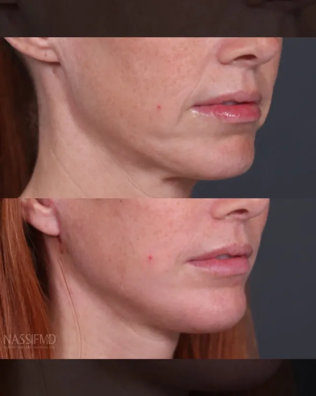 Before and after deep plane facelift, frontal view by Dr. Paul Nassif