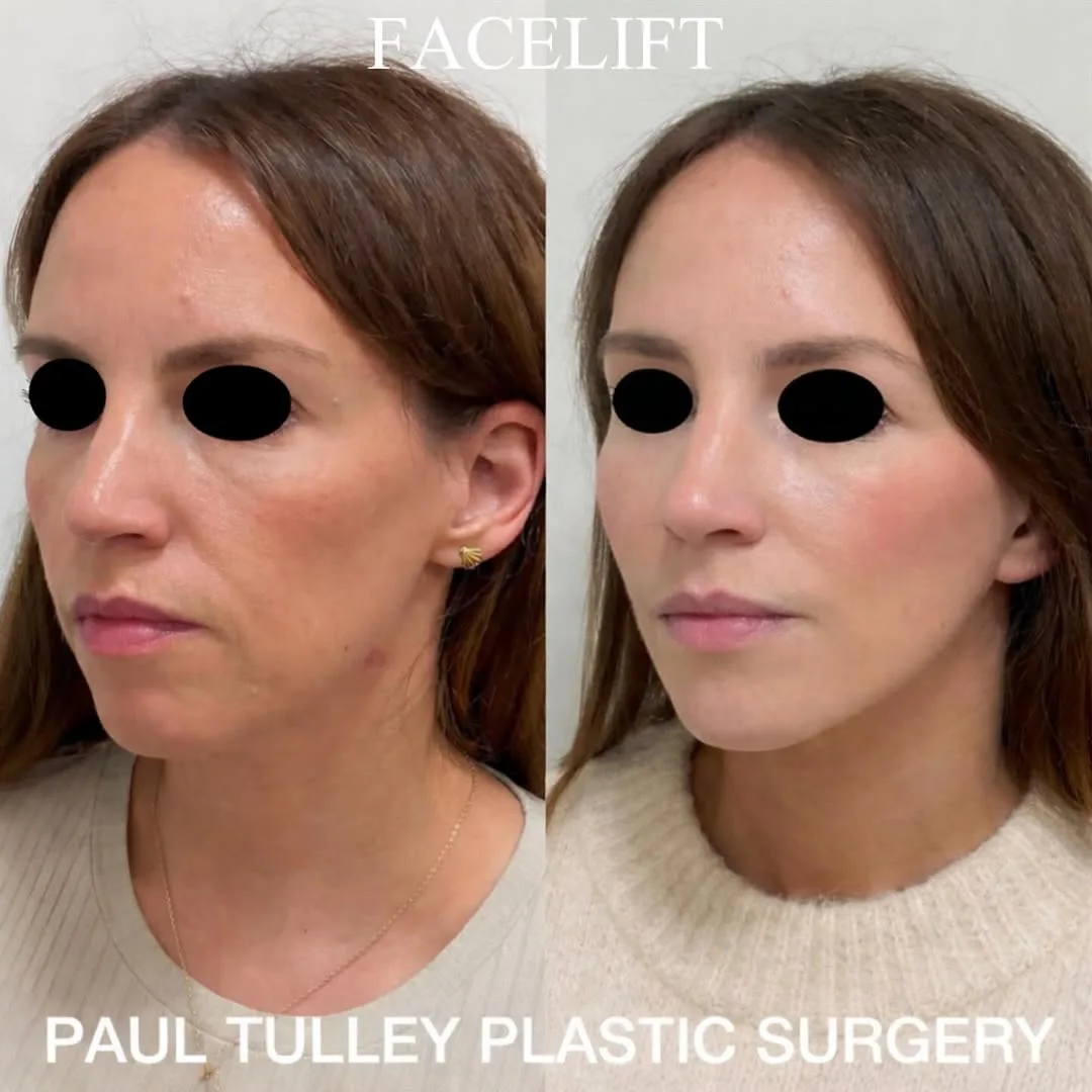 Before and after — Dr. Paul Tulley