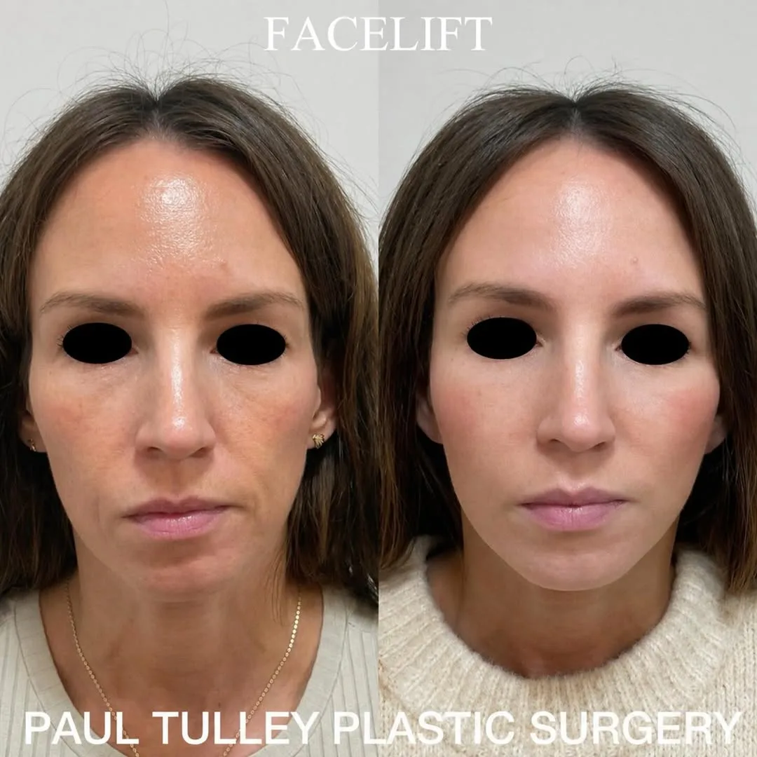 Before and after — Dr. Paul Tulley