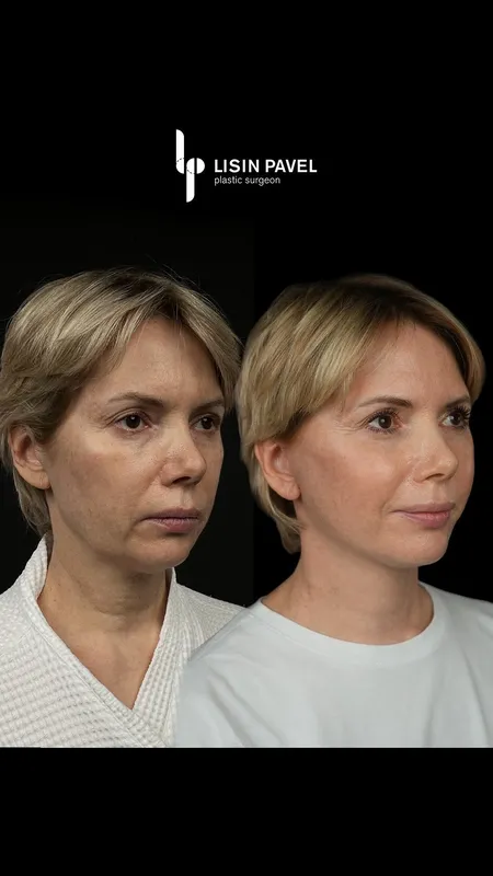 Before and after — Dr. Pavel Lisin