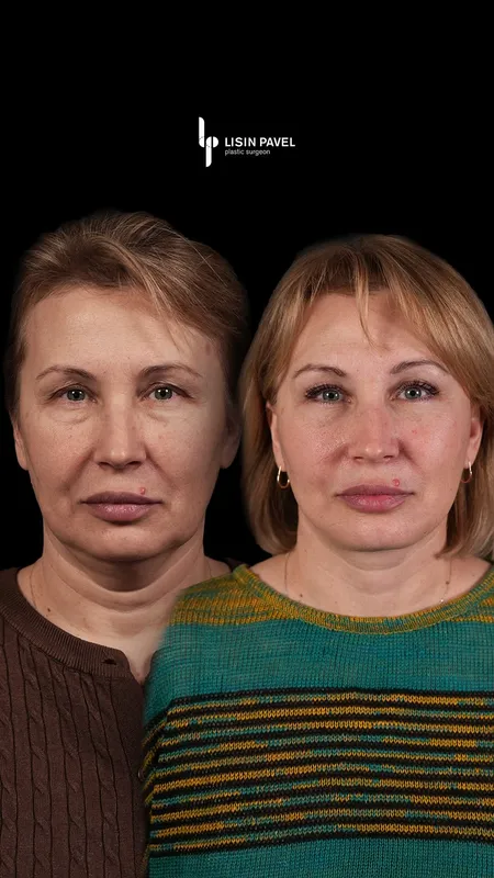 Before and after — Dr. Pavel Lisin