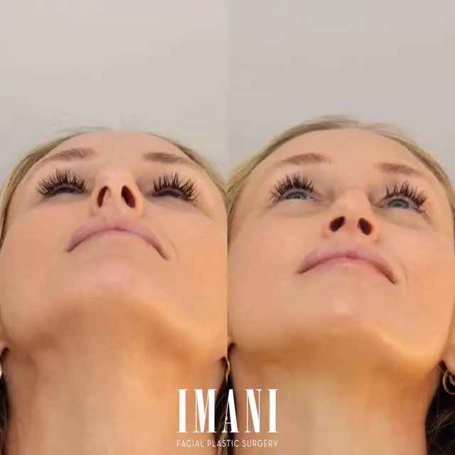 Before and after — Dr. Pedram Imani