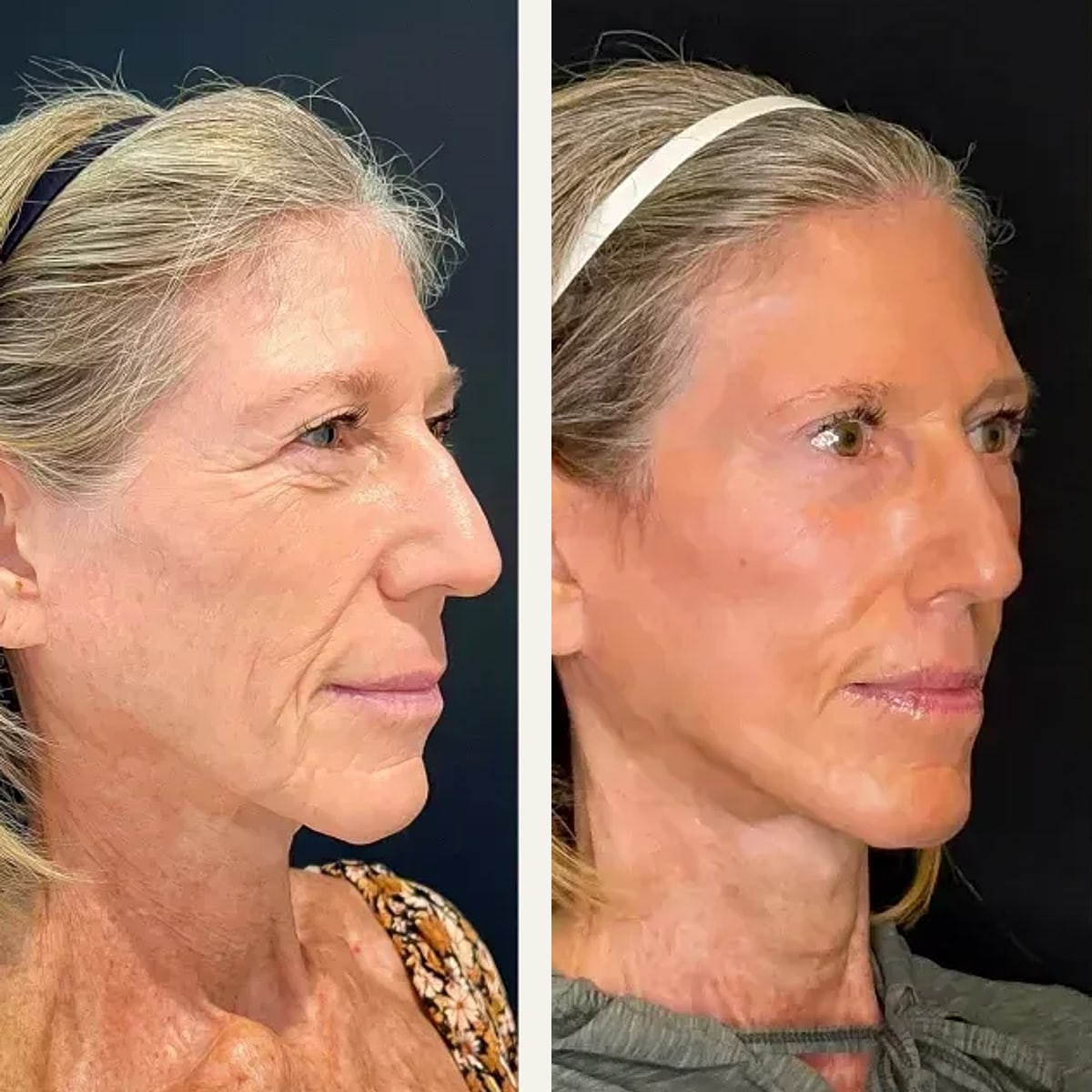 Before and after: Dr. Pedro Literas