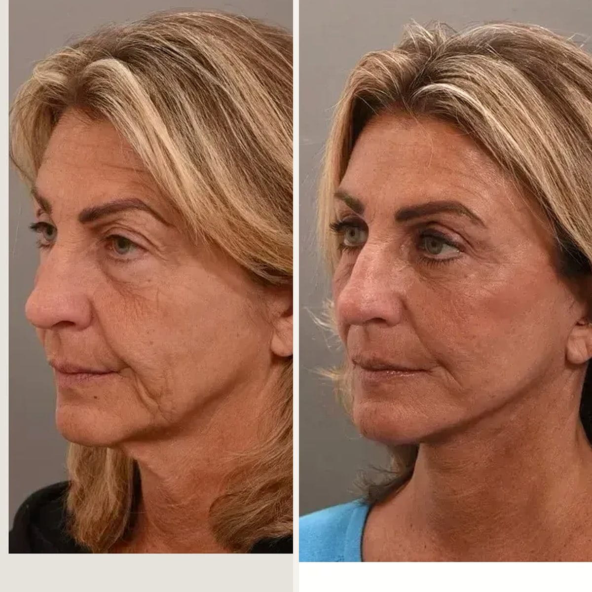 Before and after: Dr. Peggy Su-Genyk