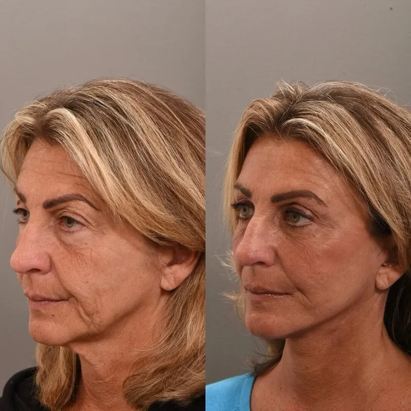 Before and after deep plane facelift — -1-year-old patient, frontal view by Dr. Peggy Sugenyk