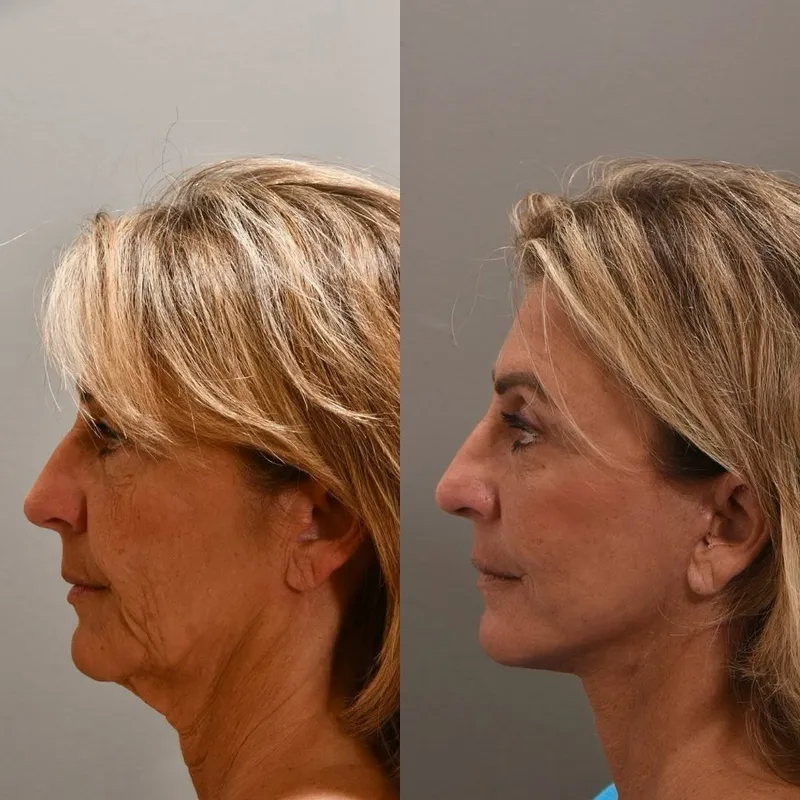 Before and after deep plane facelift — -1-year-old patient, frontal view by Dr. Peggy Sugenyk