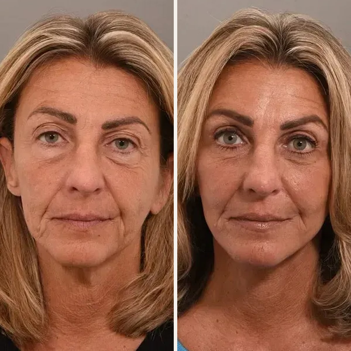 Before and after: Dr. Peggy Su-Genyk