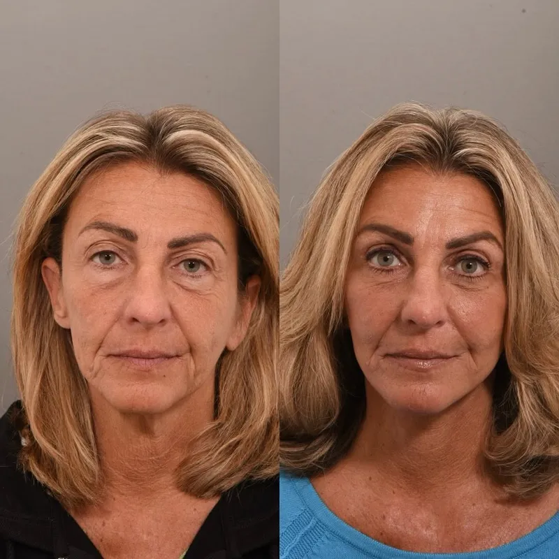 Before and after deep plane facelift — -1-year-old patient, frontal view by Dr. Peggy Sugenyk