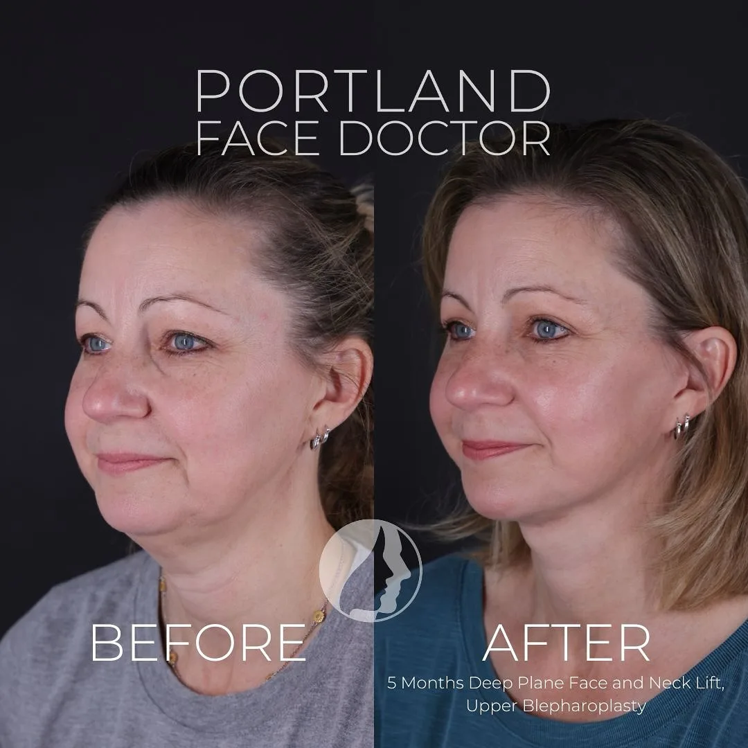 Before and after deep plane facelift — 52-year-old woman, three-quarter view, 5mo post-op by Dr. Peter Vila