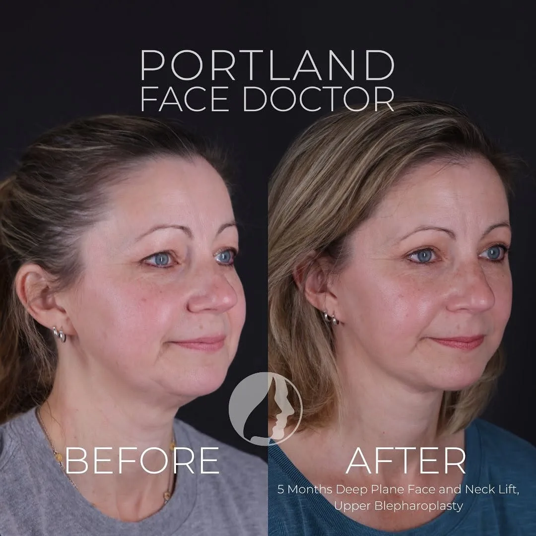 Before and after deep plane facelift — 52-year-old woman, three-quarter view, 5mo post-op by Dr. Peter Vila