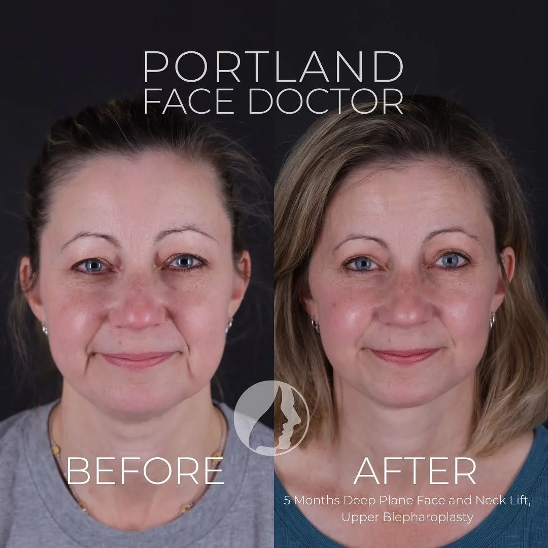 Before and after deep plane facelift — 52-year-old woman, frontal view, 5mo post-op by Dr. Peter Vila