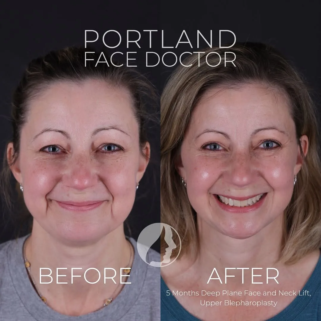 Before and after deep plane facelift — 45-year-old woman, frontal view, 5mo post-op by Dr. Peter Vila