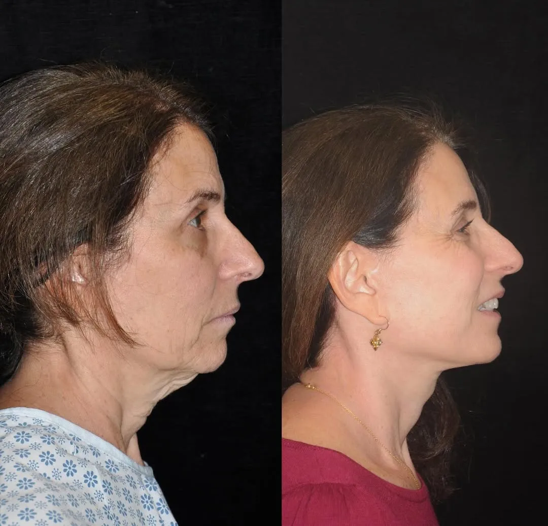 Before and after deep plane facelift — 58-year-old woman, right profile view, 6mo post-op by Dr. Philip Lotfi