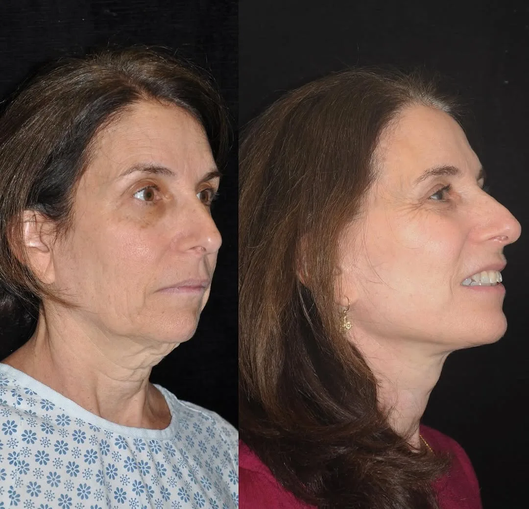 Before and after deep plane facelift — 55-year-old woman, right profile view, 6mo post-op by Dr. Philip Lotfi