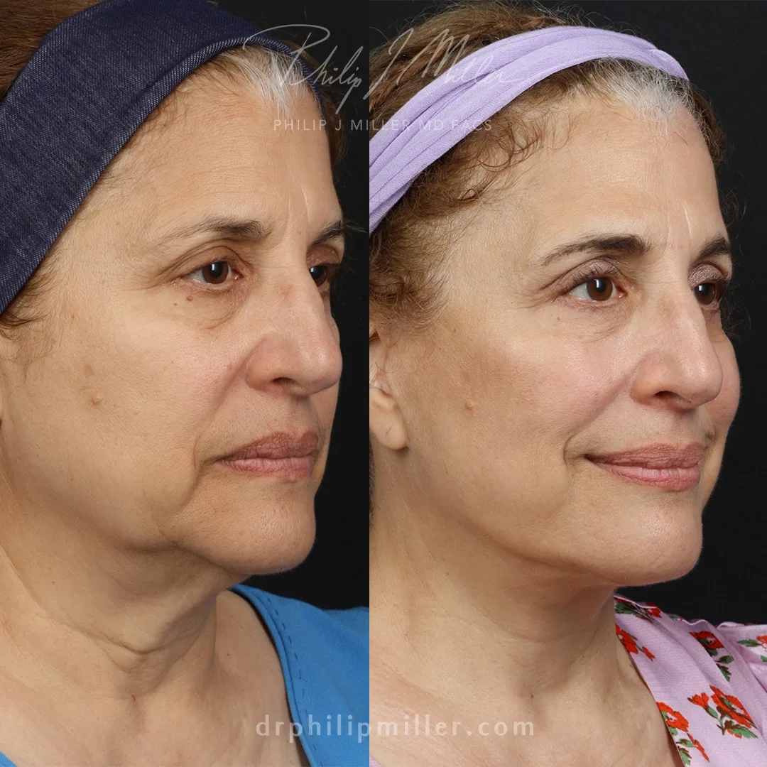 Before and after — Dr. Philip Miller
