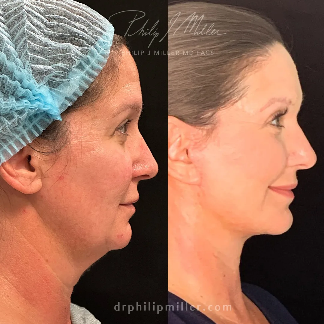Before and after — Dr. Philip Miller