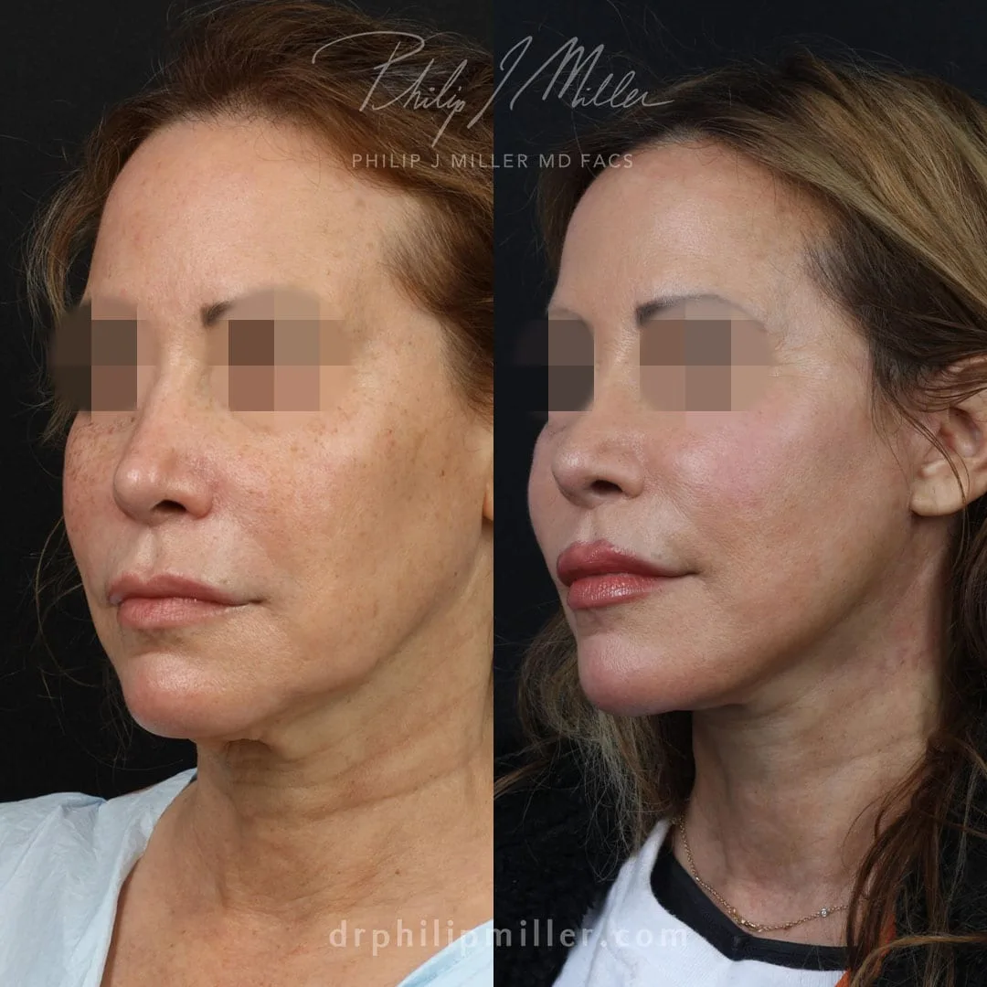 Before and after — Dr. Philip Miller