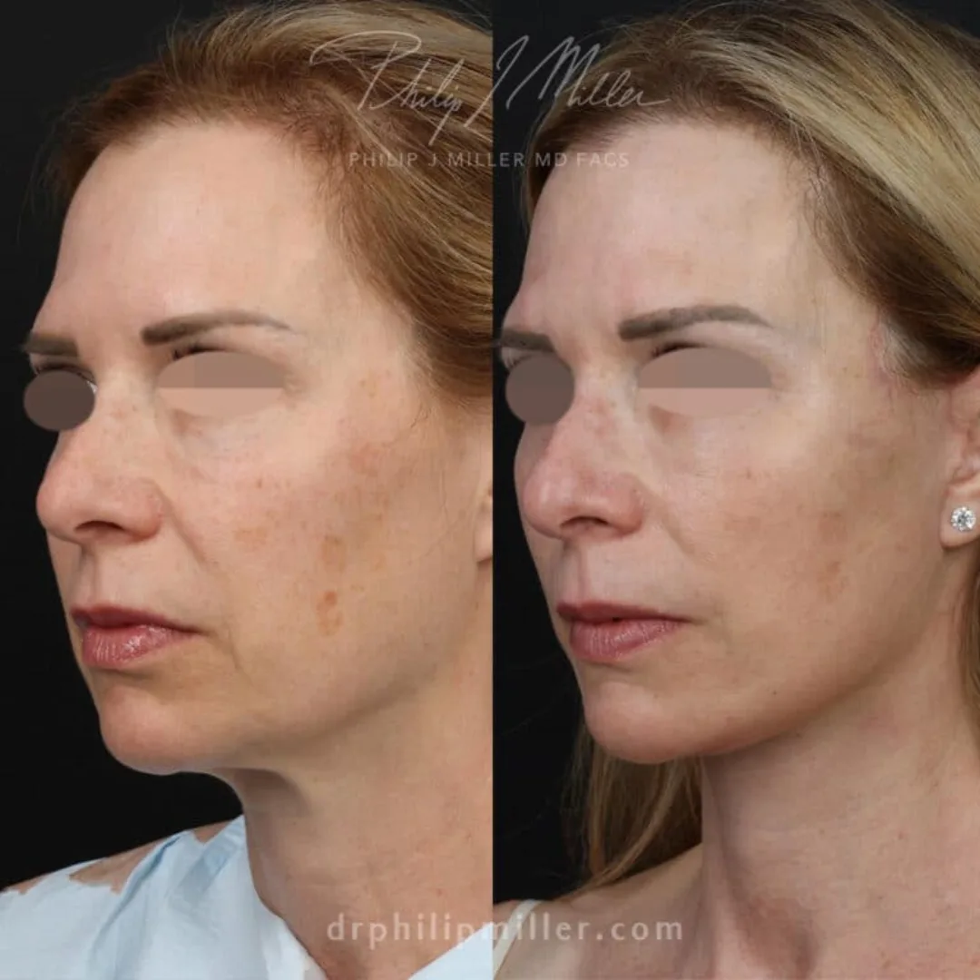 Before and after — Dr. Philip Miller