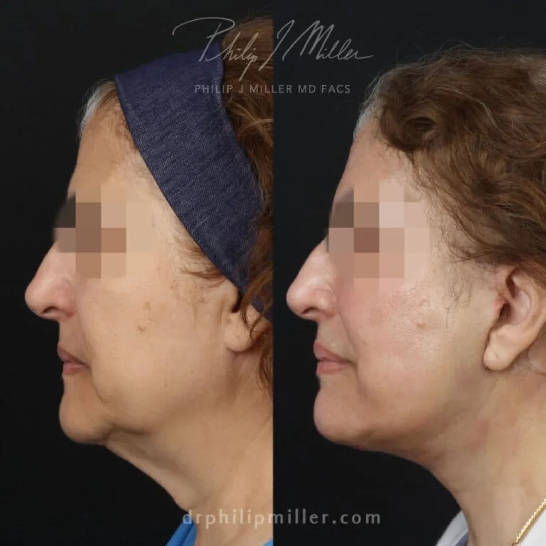 Before and after — Dr. Philip Miller