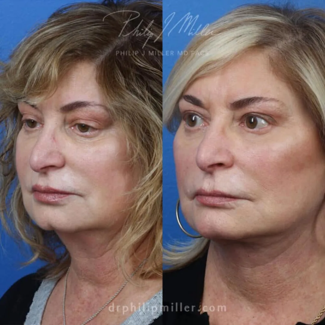 Before and after — Dr. Philip Miller