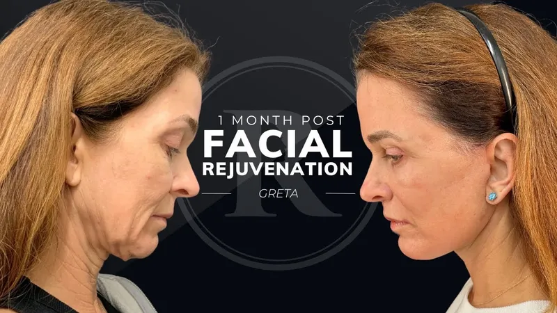 Before and after deep plane facelift, frontal view by Dr. Philip Robb Jr.