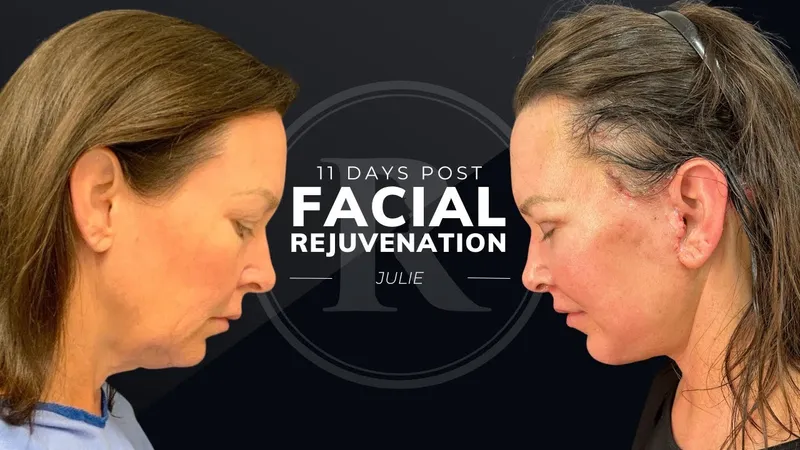 Before and after deep plane facelift, frontal view by Dr. Philip Robb Jr.