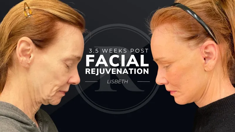 Before and after deep plane facelift, frontal view by Dr. Philip Robb Jr.
