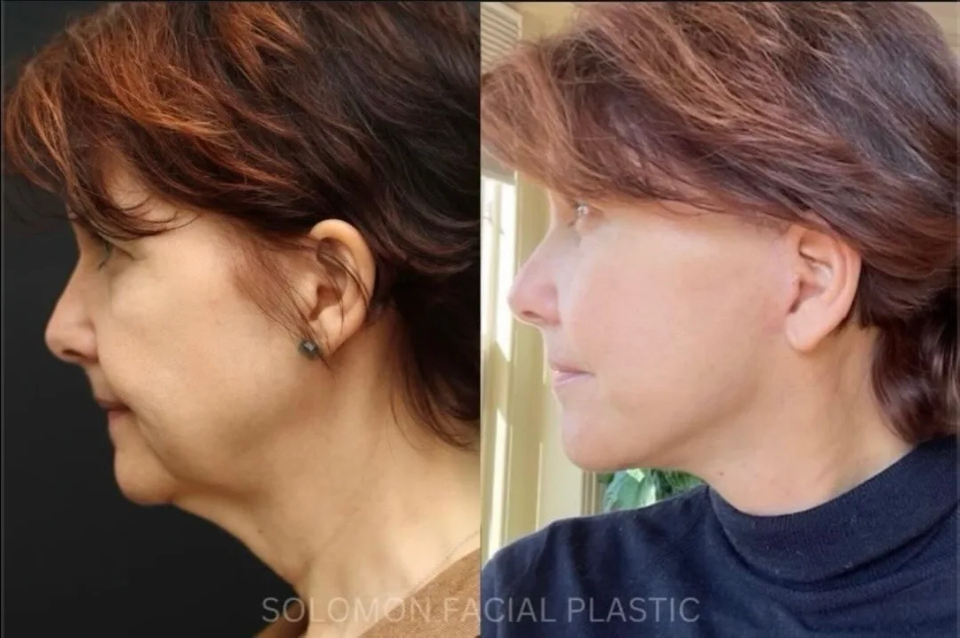Before and after deep plane facelift — 52-year-old woman, left profile view, 2mo post-op by Dr. Philip Solomon