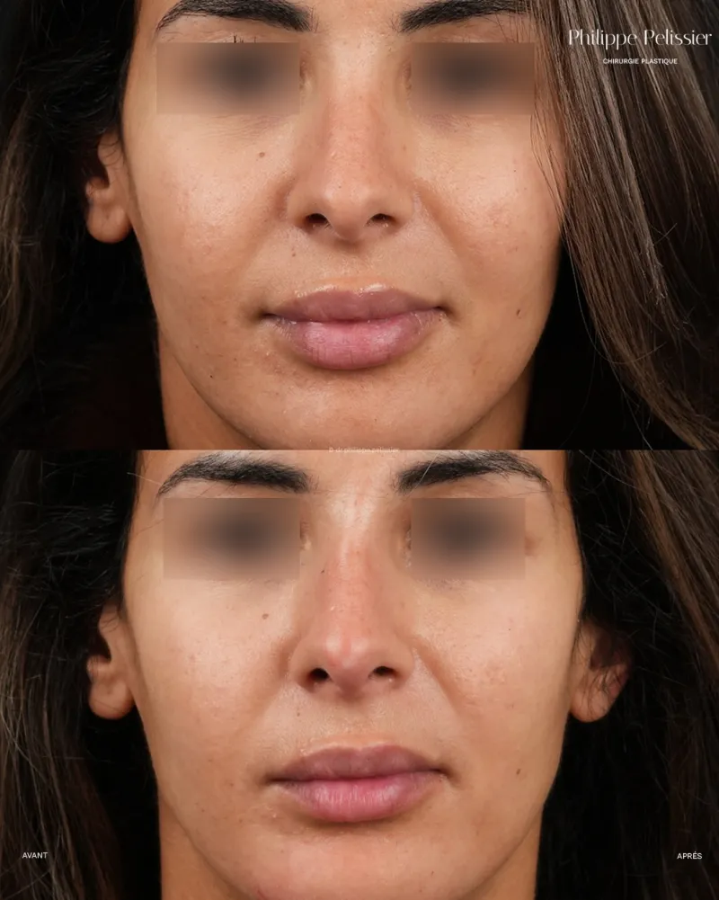 Before and after — Dr. Philippe Pelissier