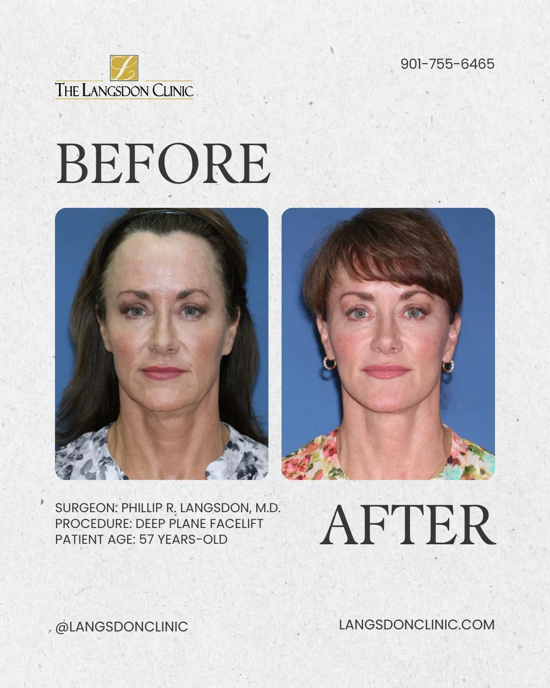 Before and after — Dr. Phillip Langsdon