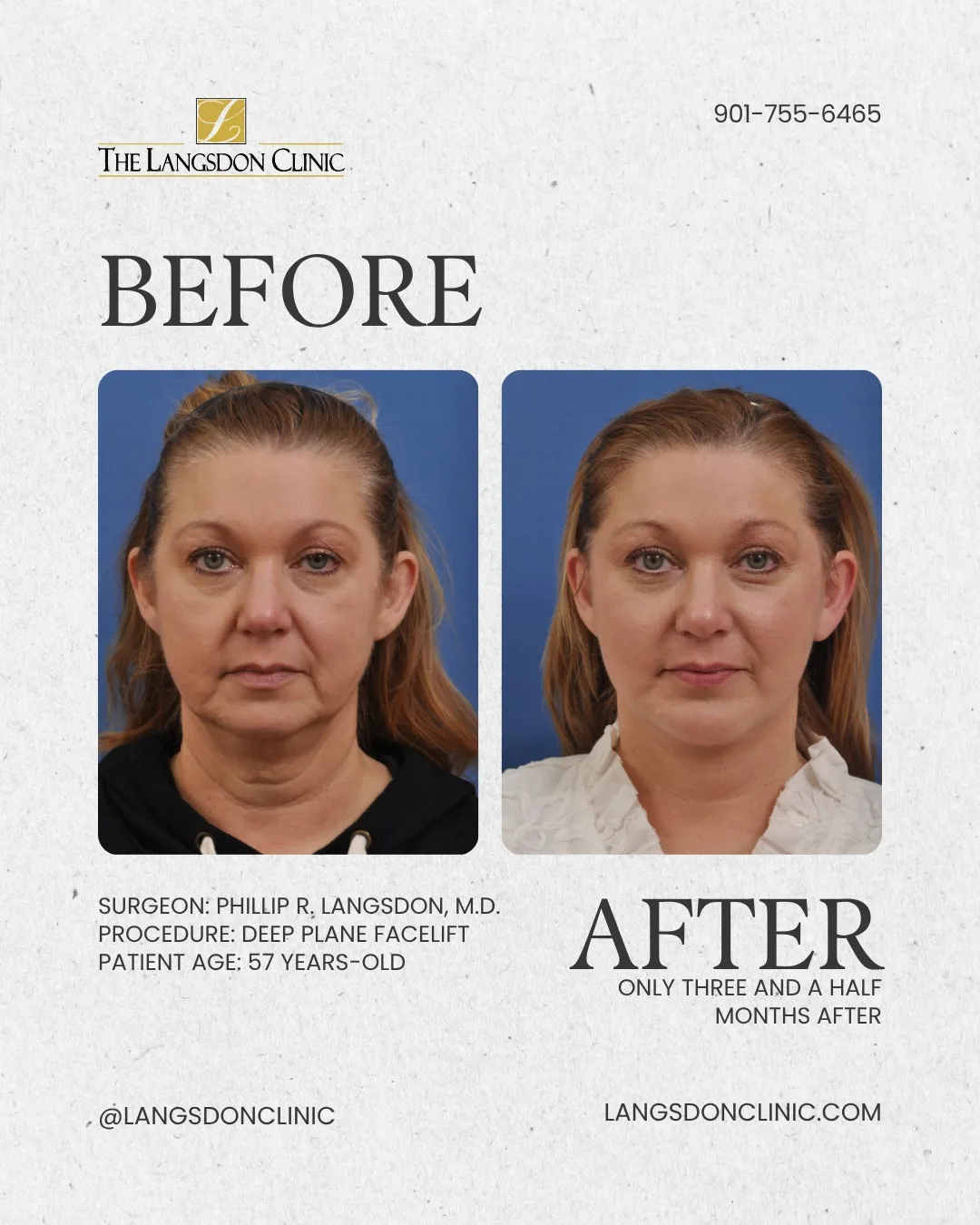 Before and after — Dr. Phillip Langsdon