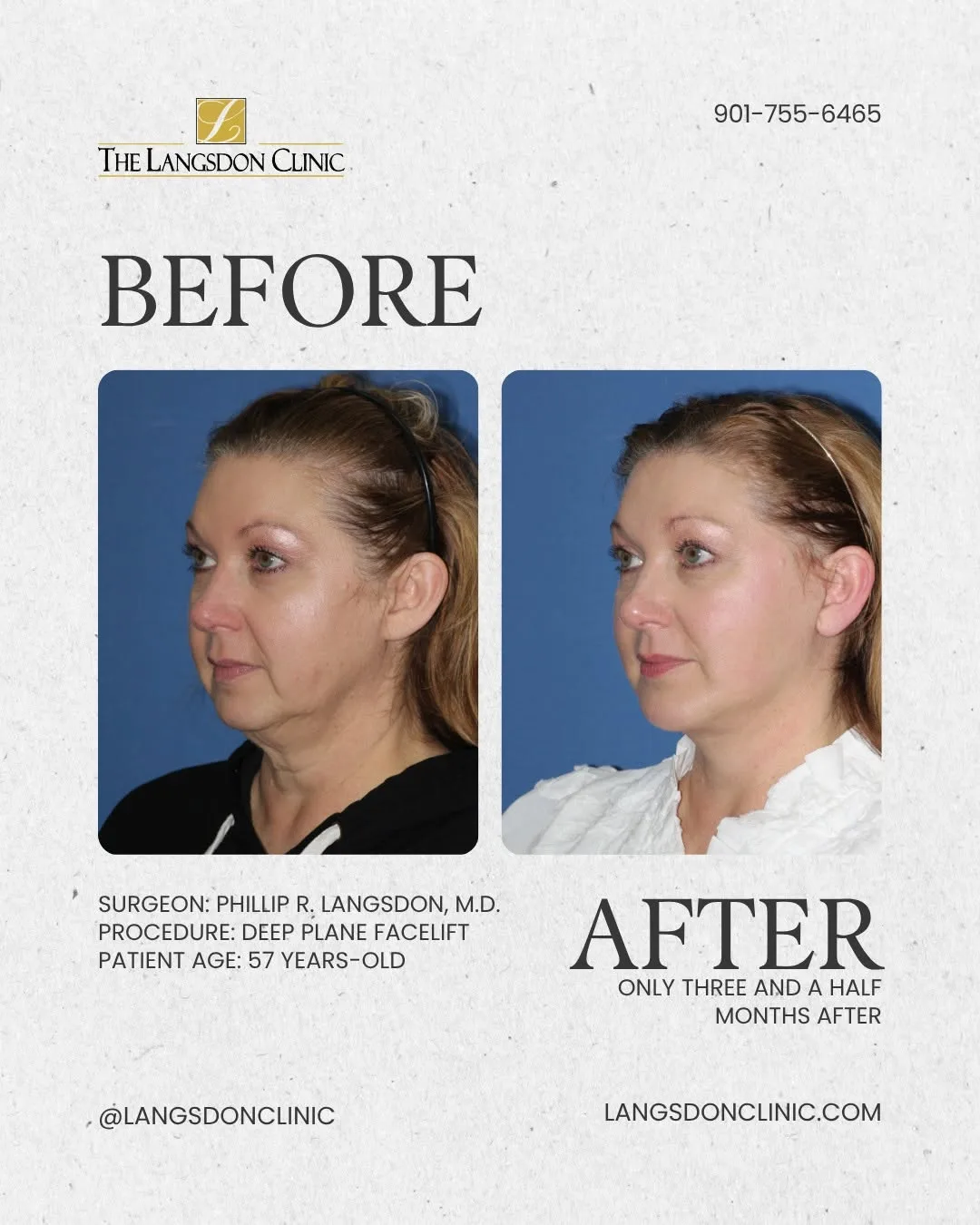 Before and after — Dr. Phillip Langsdon