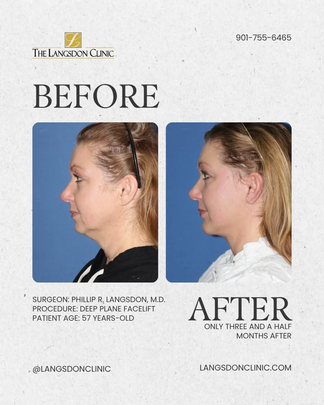 Before and after — Dr. Phillip Langsdon