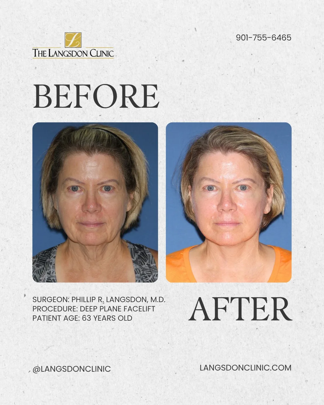 Before and after — Dr. Phillip Langsdon