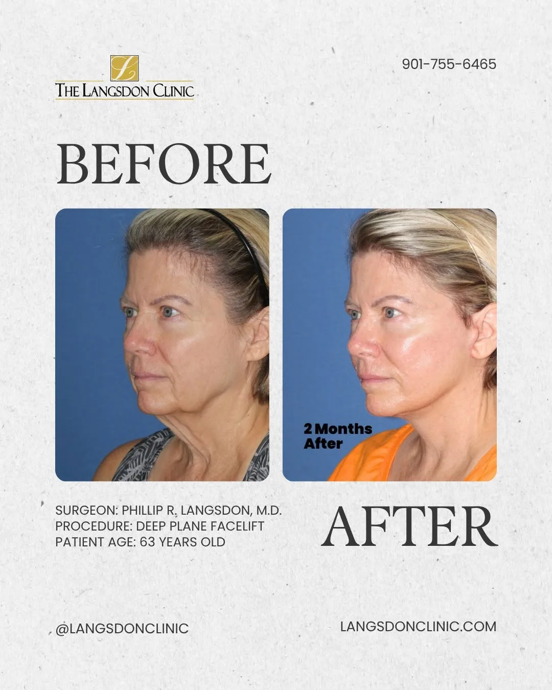 Before and after — Dr. Phillip Langsdon