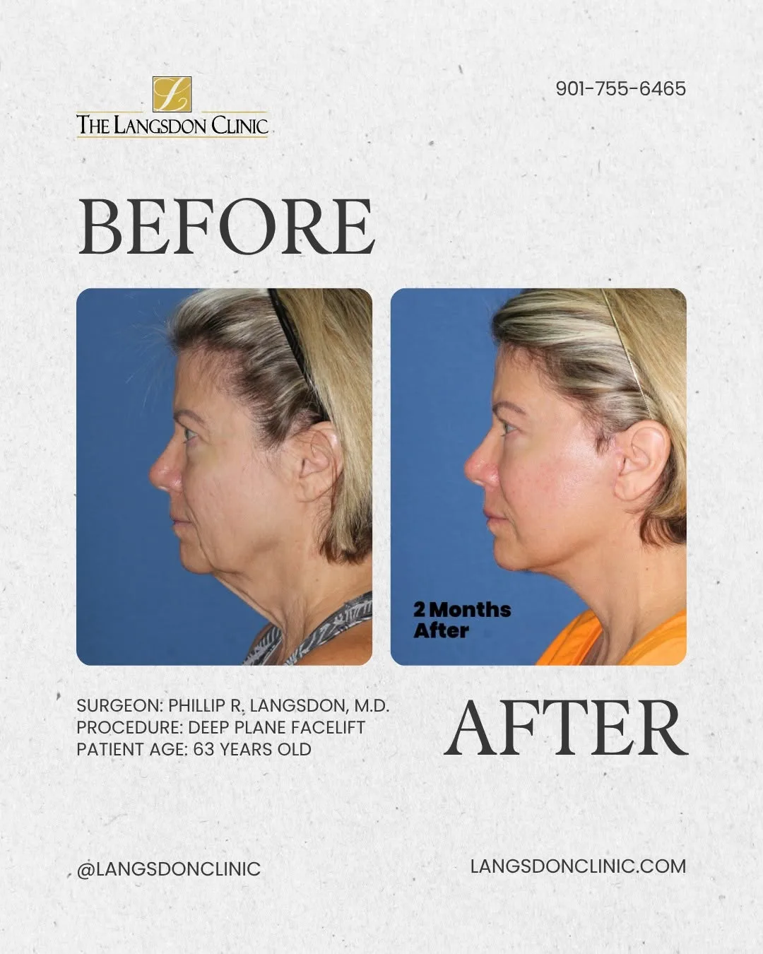 Before and after — Dr. Phillip Langsdon