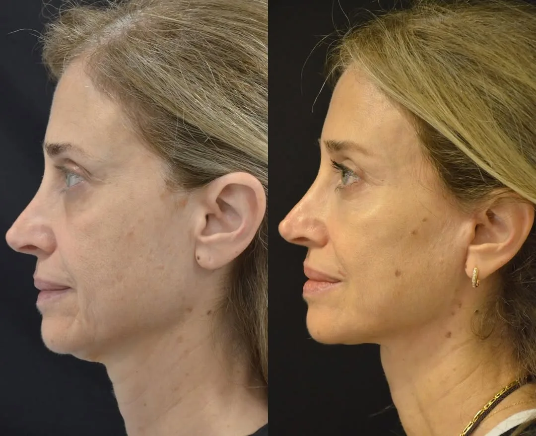 Before and after deep plane facelift — 48-year-old woman, left profile view, 6mo post-op by Dr. Pierre Abi Akl