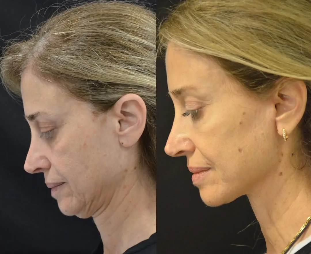 Before and after deep plane facelift — 55-year-old woman, left profile view, 6mo post-op by Dr. Pierre Abi Akl